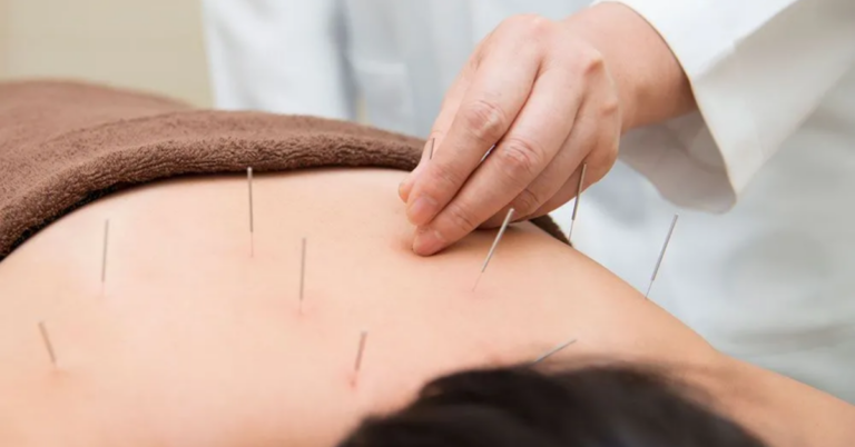 Best TCM Acupuncture Clinics in Singapore: A Comprehensive Guide